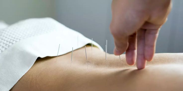 Intramuscular Stimulation